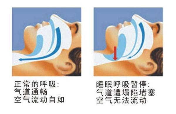 健康科普|肥胖与睡眠呼吸暂停的关系，你知道吗？